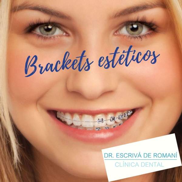 Ortodoncia estética. Tipos de brackets.
